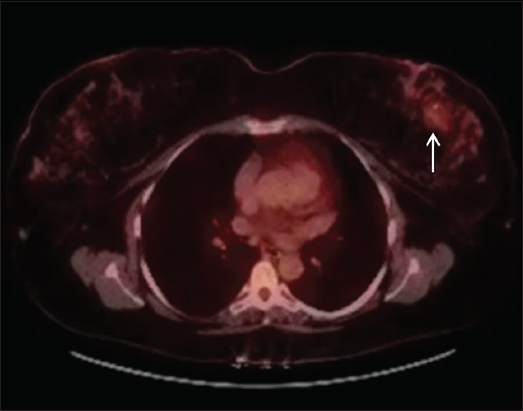 A 66-year-old female with malignant phyllodes tumor on biopsy of the left breast mass with positron emission tomography–computed tomography scan showing area of mild uptake in left breast (arrow) with no lymphadenopathy or metastasis.