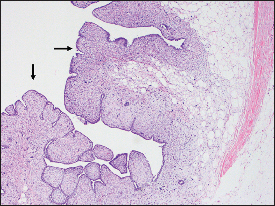 A 66-year-old female with biopsy of the breast mass. Tumor pathology slides showing a fibroepithelial lesion showing “leaf-like” architecture (arrows) of the phyllodes tumor (H and E, ×4).