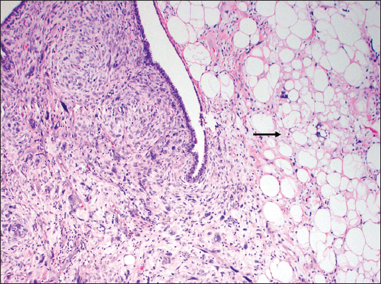 A 66-year-old female with biopsy of the breast mass. Tumor pathology slides showing heterologous liposarcomatous differentiation with variably sized, hyperchromatic, atypical adipocytes (arrow), numerous lipoblasts and high mitotic rate (H and E, ×10).