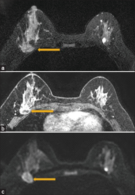 A 47 year old female with biopsy-proven right breast invasive carcinoma. Breast magnetic resonance imaging showing loss of the posterior fat plane (arrow) on T2 (a), loss of fat plane on postcontrast sequences with pectoralis muscle enhancement (arrow) (b), and diffusion restriction in the pectoralis muscle (arrow) (c). Surgical pathology demonstrated evidence of skeletal muscle involvement.