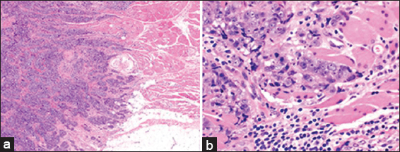 A 47 year old female with biopsy-proven right breast invasive carcinoma. Low magnification (a: H and E; ×20) and high magnification (b: H and E; ×400) micrographs demonstrate invasive ductal carcinoma, Nottingham grade III (of III) infiltrating mature skeletal muscle.