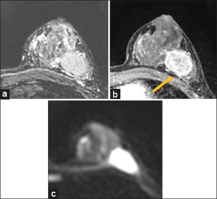 False positive. 38 year old female with invasive ductal carcinoma of the left breast with metastases to left axillary lymph nodes. Breast magnetic resonance imaging was performed prior to neoadjuvant chemotherapy. There is loss of fat plane on T2 sequences (a), and no enhancement of the pectoralis muscle (arrow) on post contrast sequences (b). Diffusion weighted imaging was interpreted as positive for pectoralis muscle invasion based on consensus read. After neoadjuvant chemotherapy, final surgical pathology did not show evidence of skeletal muscle involvement.