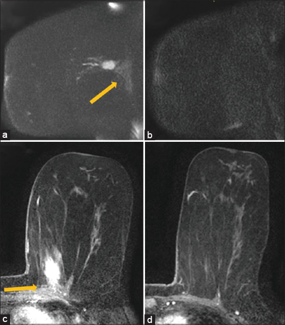 A 65 year old female with diagnosis of biopsy-proven left breast cancer in the upper inner left breast adjacent to the chest wall. Maximum intensity projection image of a sagittal diffusion weighted imaging sequence (B800 series) demonstrates bright diffusion weighted imaging signal in the lesion with slightly less bright diffusion weighted imaging signal (arrow) in the chest wall (a). This was interpreted as diffusion weighted imaging restriction in the chest wall qualitatively. The apparent diffusion coefficient value in the chest wall was 2.5. Subsequent diffusion weighted imaging image after neoadjuvant chemotherapy demonstrates resolution of previously seen diffusion restriction within the mass and in the chest wall (b). Initial magnetic resonance imaging prior to neoadjuvant chemotherapy demonstrates enhancing mass in the left breast with enhancement extending into the pectoralis muscle (arrow), compatible with chest wall invasion (c). Subsequent magnetic resonance imaging demonstrates resolution of the mass and enhancement in the pectoralis muscle (d). The pathology in this case was negative for skeletal muscle involvement but patient had received neoadjuvant chemotherapy.