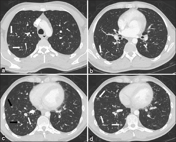 28-year-old man with a history of human immunodeficiency virus/acquired immunodeficiency syndrome complicated by numerous prior opportunistic infections, presented with progressive dyspnea and chronic, nonproductive cough, diagnosed with pulmonary Kaposi sarcoma. Computerized tomography chest, lung window. Panels a-d demonstrating multiple, right greater than left-sided, ill-defined ground glass (white arrows) and solid (black arrows) peribronchovascular nodules.