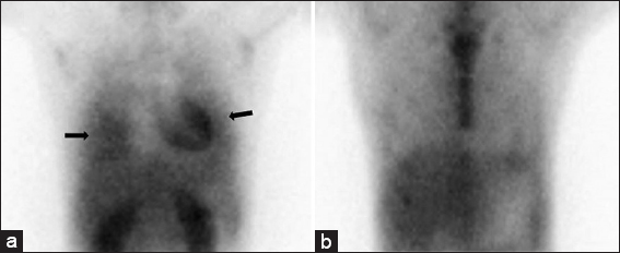 28-year-old man with a history of human immunodeficiency virus/acquired immunodeficiency syndrome complicated by numerous prior opportunistic infections, presented with progressive dyspnea and chronic, nonproductive cough, diagnosed with pulmonary Kaposi sarcoma. Scintigraphy demonstrating right greater than left lung delayed thallium uptake (panel a; black arrows) without corresponding gallium uptake (panel b).