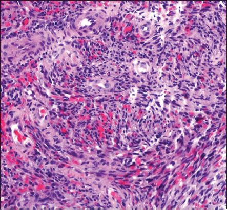 28-year-old man with a history of human immunodeficiency virus/acquired immunodeficiency syndrome complicated by numerous prior opportunistic infections, presented with progressive dyspnea and chronic, nonproductive cough, diagnosed with pulmonary Kaposi sarcoma. Submandibular lymph node biopsy showing central sarcomatoid proliferation (hematoxylin and eosin, original magnification ×100).