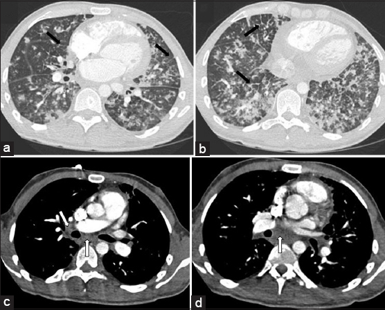 28-year-old man with a history of human immunodeficiency virus/acquired immunodeficiency syndrome complicated by numerous prior opportunistic infections, presented with progressive dyspnea and chronic, nonproductive cough, diagnosed with pulmonary Kaposi sarcoma. Computerized tomography chest, lung window. Panels a and b demonstrating progressive bilateral ill-defined ground glass and solid peribronchovascular nodules, and interlobular septal thickening (black arrows). Computerized tomography chest with IV contrast, soft-tissue window. Panels c and d demonstrating mediastinal and hilar lymphadenopathy (white arrows).