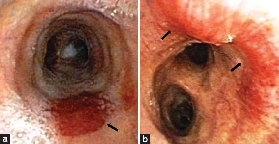28-year-old man with a history of human immunodeficiency virus/acquired immunodeficiency syndrome complicated by numerous prior opportunistic infections, presented with progressive dyspnea and chronic, nonproductive cough, diagnosed with pulmonary Kaposi sarcoma. Bronchoscopy images. Panel a and b showing characteristic red to slightly violaceous macular lesions in the mid and distal trachea (black arrows).