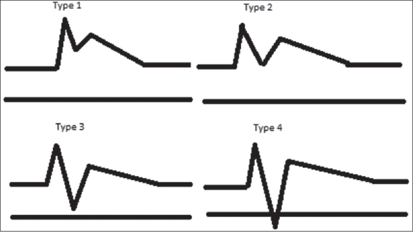 Schematic representation of the types of presteal waveforms.