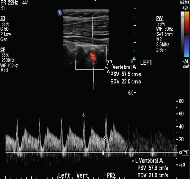 A 62-year-old female for pre bypass graft workup. Left vertebral artery Doppler tracing showing two systolic peaks and the flow velocity at the nadir of the notch equal to or less than the flow velocity at the end diastole suggesting Type 2 waveform.