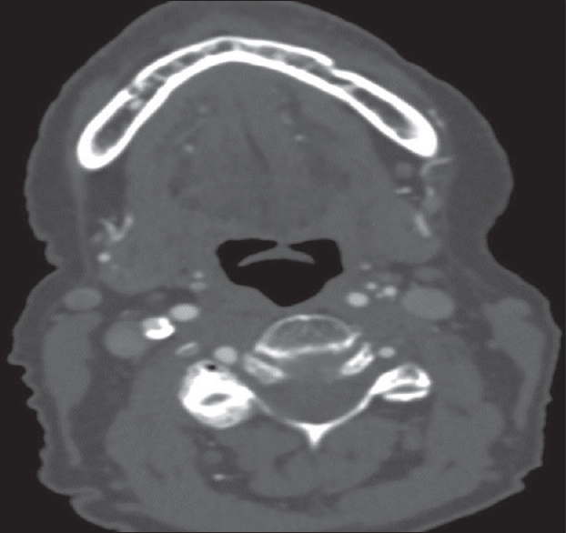 An 87-year-old female with transient speech difficulty. Computed tomography angiography of neck of the same patient as Figure 3, showing patent bilateral vertebral arteries.