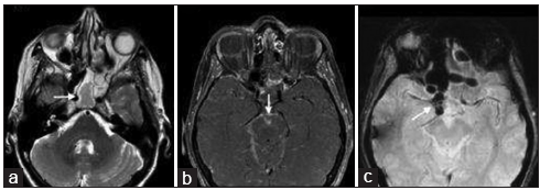 A 62-year-old woman presenting with headache and vertigo found to have meningitis, secondary to the intracranial extension from sinusitis. (a) T2-weighted axial MRI image through the brain demonstrates T2 hyperintensity within the left sphenoid and ethmoidal air cells (arrow). (b) Contrast-enhanced axial MRI image of the brain demonstrates leptomeningeal enhancement (arrow) in the interpeduncular fossa and along the cerebral peduncles, consistent with meningitis. (c) Susceptibility-weighted MRI image demonstrates round foci of susceptibility hypointensity in the parasellar region with blooming artifact (arrow), consistent with pneumocephalus.