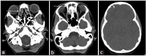 A 9-year-old boy presenting with headache and vertigo found to have frontal sinusitis and pneumocephalus. (a-c) Axial non-contrast CT images of the head demonstrate fluid attenuation within the bilateral ethmoid sinuses, frontal sinuses, and a small right frontal focus of pneumocephalus (arrows).