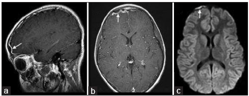 A 9-year-old boy with frontal sinusitis and pneumocephalus found to have an epidural abscess. (a) Sagittal and (b) axial gadolinium-enhanced T1-weighted MR images of the brain demonstrate a contrast-enhancing fluid collection (arrow) overlying the right frontal lobe. (c) The diffusion-weighted image demonstrates restricted diffusion, compatible with an epidural abscess (arrow).