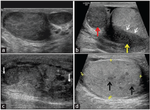 Various examples of gray scale sonographic patterns of testicular tuberculosis. (a) Diffusely enlarged right testis with heterogeneous hypoechoic pattern, (b) diffusely enlarged head (red arrow) and body (yellow arrow) of epididymis with infiltration of adjacent testes parenchyma (white arrows) showing homogenous hypoechoic pattern, (c) nodular enlarged heterogeneously hypoechoic testes, with ill-defined nodules (small white arrows) virtually indistinguishable from tumor, (d) ill-defined tiny hypoechoic nodules (black arrows) in testicular parenchyma.