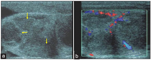 A 44-year-old man with testicular tuberculosis who presented with 6 months history of testicular pain. (a) Gray scale sonographic image demonstrates an enlarged and heterogeneous testis with the presence of multiple ill-defined focal hypoechoic lesions (small yellow arrows). (b) Color Doppler shows increased vascularity along the periphery of the hypoechoic lesions. These imaging findings are non-specific and may be seen in both inflammatory and neoplastic conditions. A diagnosis of testicular tuberculosis was made the following orchiectomy.