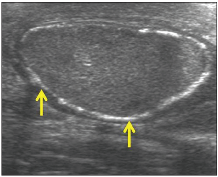 A 42-year-old man with healed testicular tuberculosis: Gray scale sonographic image demonstrates smooth peripheral calcification along the tunica vaginalis (yellow arrows). The patient had a remote history of pulmonary tuberculosis, which was treated with antitubercular drugs.