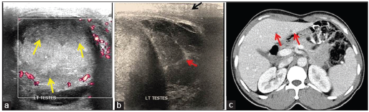 A 43-year-old male with complicated testicular tuberculosis presenting with scrotal pain and swelling. (a) Color Doppler sonographic image demonstrates diffuse, ill-defined heterogeneous hypoechoic area with increased peripheral vascularity but lack of central vascularity (yellow arrows). (b) Gray scale ultrasound image showing scrotal wall edema (black arrow) and multiseptated hydrocele and debris (red arrow). (c) Contrast-enhanced axial computed tomography image of abdomen in same patient shows hypoechoic lesions in the left lobe of liver (red arrows) likely representing tubercular granulomas.