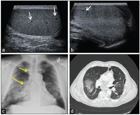 A 55-year-old-male with sarcoidosis who presented with the right testicular pain. (a and b) Gray scale sonographic image of testis revealed several, tiny bilateral hypoechoic lesions (white arrows) on both testes (A-right, B-left testis). (c) Frontal chest radiograph shows the right hilar and paratracheal lymphadenopathy (yellow arrows) and bilateral interstitial and airspace opacities more on the right side. (d) Axial computed tomography chest image on lung window demonstrates asymmetric ground-glass opacities with surrounding pulmonary fibrosis and architecture distortion more prominent on the right.