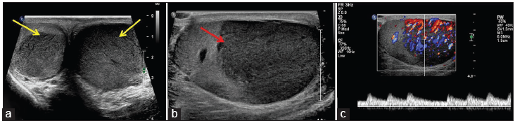 A 70-year-old elderly male with lymphoma who presented with scrotal swelling. (a) Gray scale ultrasound shows bilateral enlarged testes with bilateral hypoechoic masses (yellow arrows). (b) Note the diffuse involvement of the left testis by hypoechoic mass (annotated with red arrow). (c) Color Doppler image showing profound vascularity concerning for tumor. A presumptive diagnosis of testicular tumor was made based on the patients age, clinical presentation, and sonographic findings. Histopathological examination of the left orchiectomy specimen revealed non-Hodgkin’s lymphoma.