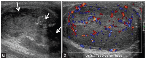 A 30-year-old male with testicular tumor who presented with progressive right scrotal pain and swelling for a month. (a) Gray scale sonographic image demonstrates heterogeneous testis with multiple focal hypoechoic lesions with punctate calcifications (white arrows). The imaging features are simulating malignancy. (b) On color Doppler, peripheral and central vascularity is seen. This was found to be testicular undifferentiated sarcoma.