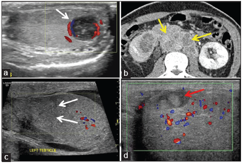 Tuberculosis mimics. A 20-year-old male with scrotal pain. (a) A well-defined heterogeneous hypoechoic lesion in lower pole of testes (white arrow) with peripheral flow on color Doppler. (b) Axial contrast-enhanced computed tomography abdomen of same patient revealed bulky conglomerate lymphadenopathy (yellow arrows) diagnosed as germ cell tumor. (c) A 16-year-old male with trauma. Irregular hypoechoic area in upper pole of testis (white arrows) with minimal hydrocele. (d) A 35-year-old male for follow-up of testicular trauma. Avascular heterogeneous lesion in upper pole of testis (red arrow) diagnosed as hematoma.