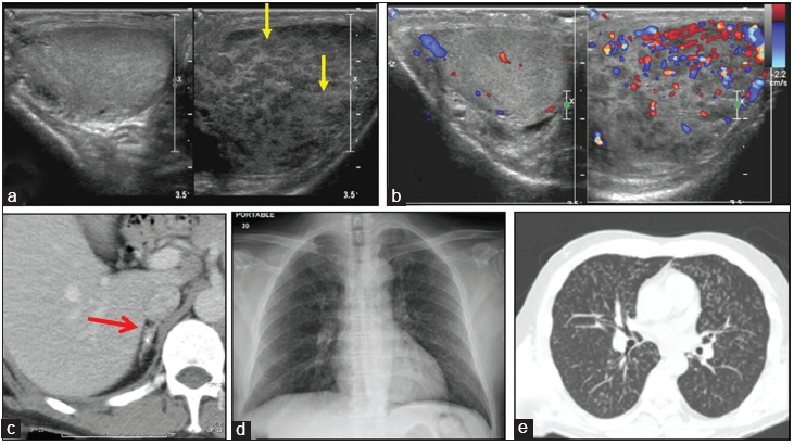 Testicular tuberculosis mimicking tumor; importance of extratesticular ancillary findings. (a) Gray scale sonographic image of scrotum showing enlarged left testis with multifocal ill-defined hypoechoic nodularity (yellow arrows). (b) Color Doppler shows increased vascularity. The left radical orchiectomy revealed caseous granulomatous orchitis and epididymitis. (c) Retrospective analysis of contrast-enhanced computed tomography (CT) abdomen shows calcified right adrenal gland (red arrow). (d) Chest X-ray was normal and (e) CT chest revealed bilateral lung parenchyma studded with multiple miliary tubercles.