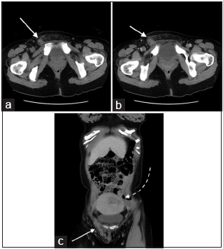 A 35-year-old postpartum woman presenting with a right groin mass due to a thrombosed round ligament varicosity. (a) Axial non-contrast computed tomography (CT) scan of the pelvis at the groin level shows a hyperdense serpentine structure (white arrow), extending from the right deep inguinal ring along the inguinal canal to the labia majora compatible with a round ligament varicosity. Surrounding fat stranding is present due to thrombosis. (b) Axial contrast-enhanced CT scan of the pelvis at the groin level shows a lack of enhancement of the round ligament varicosity, supporting the presence of thrombosis. (white arrow). (c) Coronal contrast-enhanced CT again illustrates the thrombosed right round ligament varicosity in the right groin with better demonstration of its course in the inguinal canal (white solid arrow). The gravid uterus (white-dashed arrow) is seen.