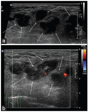 A 35-year-old postpartum woman presenting with a right groin mass due to a thrombosed round ligament varicosity. (a) Grayscale USG of the right groin shows multiple hypoechoic serpentine structures (white arrows) in the subcutaneous layer with “a bag of worm” appearance, compatible with round ligament varicosity. (b) Corresponding color Doppler ultrasound of the right groin mass shows absence of Doppler signal within the vessels (white arrows) which suggest the presence of thrombosis.