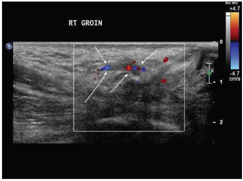 Six weeks after initial presentation and treatment with enoxaparin, there was clinical resolution of the right groin mass in this 35-year-old postpartum woman. On this color Doppler ultrasound image, the round ligament veins are no longer dilated. The presence of flow signal (white arrows) within the veins suggests recanalization and resolution of varicosity.