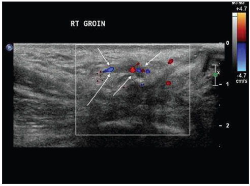 round ligament inguinal canal