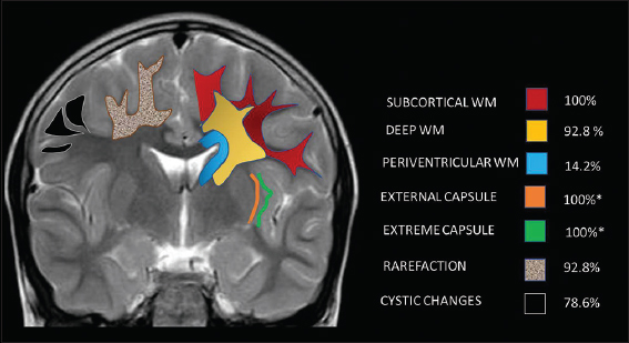 Pictorial illustration of distribution and pattern of white-matter involvement.*12/12 children above 1 year.