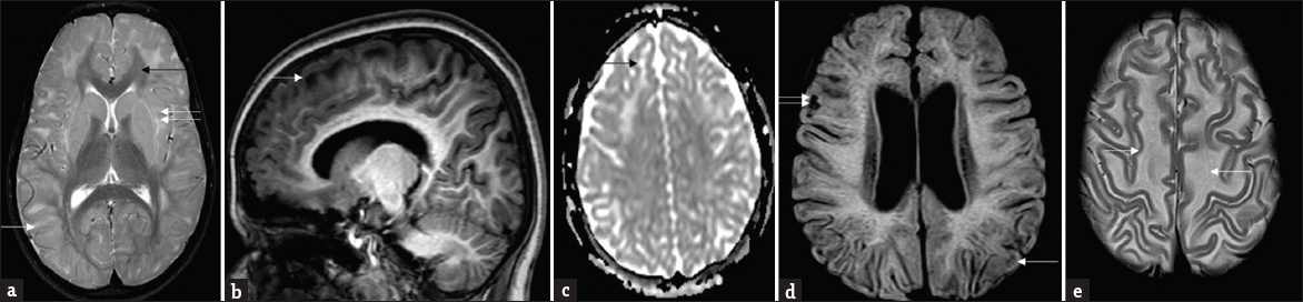 Patterns of white-matter involvement: Composite representative images from our series: T2 axial (a) shows symmetrical subcortical white-matter hyperintensities (white arrow) sparing deep and periventricular white matter, posterior limb of internal capsule, and corpus callosum (black arrow). Note signal changes of external and extreme capsule (double arrows). T1 sagittal image (b) shows subcortical and frontal predominance. Apparent diffusion coefficient map (c) shows facilitated diffusion (black arrow). Note small areas of rarefaction (white arrow) and cystic changes (double arrows) involving subcortical white matter on fluid-attenuated inversion recovery (d). Also seen is relative prominence of lateral ventricles. T2 axial images at supraventricular level (e) demonstrates mild swelling of frontal white matter (white arrows).