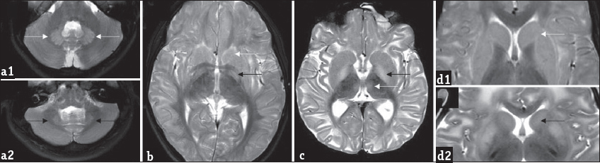 Patterns of gray matter involvement: Composite representative images from our series: Bilateral symmetric dentate hyperintensity is seen on T2 axial images in two patients (a1 and a2), while mild swelling is appreciable in a1, relative volume loss is seen in a2. T2 axial image (b) shows bilateral caudate, putamen, and globus pallidus involvement (white arrow). Note the laminar sparing of globus pallidus (black arrow). T2 axial image (c) in another patient shows absence of laminar sparing of globus pallidus (black arrow) as well as bi-thalamic paramedian signal changes (white arrow). T2 axial (d1) images show peripheral rim of hyperintensity along the caudate and putamen (white arrow), T2 axial (d2) images in another patient show central predominant involvement (black arrow).