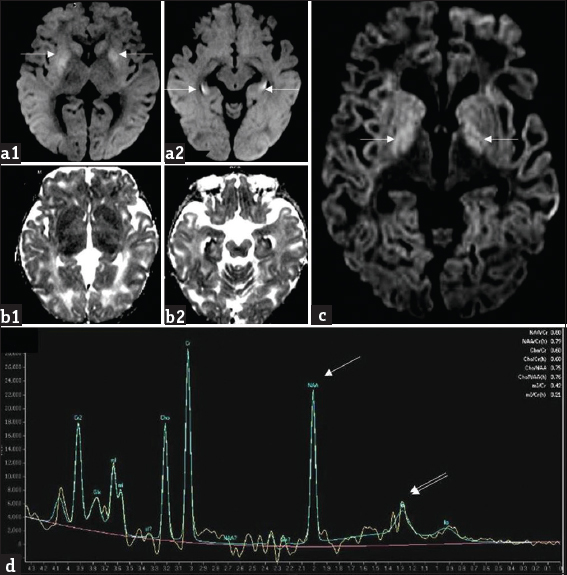 A 1-year-old girl with L-2-hydroxy glutaric aciduria presenting with febrile status epilepticus: Diffusion-weighted imaging (a1, a2) and apparent diffusion coefficient (b1, b2) images show symmetric bilateral restricted diffusion involving caudate and putamen as well as along the periphery of hippocampi (white arrows). Axial diffusion-weighted imaging image (c) from another patient, a 10-year-old girl with progressive ataxia shows milder signal changes of globus pallidus (white arrows). Magnetic resonance spectroscopy (d) from the same patient shows reduction in NAA peak at 2 ppm (white arrow) and presence of lipid lactate peak at 0.8–1.4 ppm (double arrows).