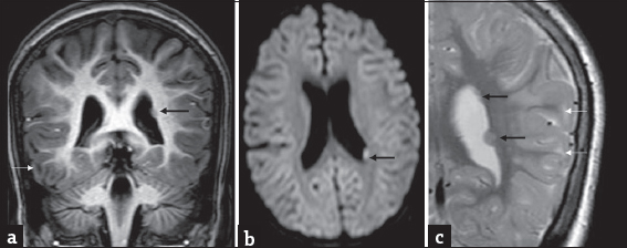 A 7-year-old girl with progressive ataxia and past history of febrile seizures diagnosed with L-2-hydroxy glutaric aciduria : Incidental finding of left subependymal nodular heterotopia on magnetic resonance imaging. T1 coronal (a) axial diffusion-weighted imaging (b) and T2 coronal (c) show small nodular subependymal heterotopia (black arrows) paralleling gray matter signal. T2 image also shows smaller heterotopias more superiorly. Note the subcortical white matter signal changes related to L-2-hydroxy glutaric aciduria (white arrows) seen in all images.