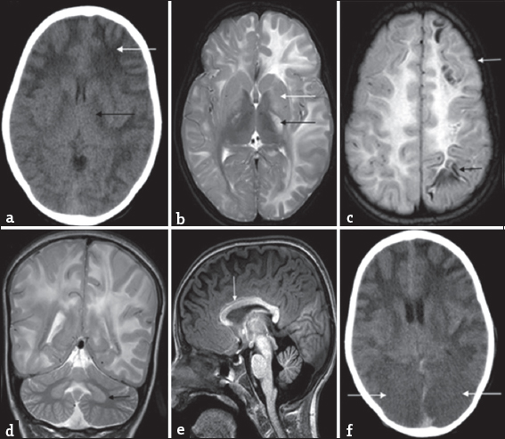 Serial imaging findings in a 9-year-old boy with acute encephalopathy and seizures (Case 2): Initial computed tomography (a) shows extensive asymmetric white-matter involvement with left-sided predominance (white arrow). Posterior limb of internal capsule involvement (black arrow) is also appreciable along with lateral ventricular effacement. Magnetic resonance imaging brain done 1 month later (b-e) again shows extensive asymmetric white-matter involvement with left-sided predominance. Note the periventricular involvement, confluent nature, and swelling appreciable on the left side. Bilateral asymmetric posterior limb of internal capsule involvement is also noted (black arrow) along with signal changes in basal ganglia (white arrow) and thalamic sparing on T2 axial image (b). Fluid-attenuated inversion recovery image (c) shows subcortical cystic changes in frontal and parietal lobes (black arrow). Also note the cortical swelling and signal changes in the left frontal lobe (white arrow). T2 coronal image (d) shows bilateral dentate involvement (black arrow). T1 sagittal image (e) shows anterior predominant callosal involvement (white arrow) as well as frontal predominance of white-matter involvement. Subsequent computed tomography done 2 weeks later (f) shows bilateral occipital hypodensities with loss of gray-white differentiation (white arrows), possibly representing posterior cerebral artery infarcts secondary to transtentorial herniation.