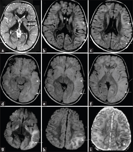 Magnetic resonance imaging findings in an 8-year-old boy presenting with progressive ataxia (Case 7): Initial magnetic resonance imaging shows subcortical predominant white-matter involvement (white arrows) along with symmetric signal changes of caudate, putamen, and globus pallidus (black arrows) on T2 axial images (a). Axial fluid-attenuated inversion recovery images (b and c) show asymmetry of white matter changes, with left side showing more confluent and extensive findings in posterior frontal and parieto-temporal regions Axial fluid-attenuated inversion recovery images (d-f) from subsequent magnetic resonance imaging after 5 years during the acute presentation shows extensive asymmetric gyral swelling and confluent white-matter signal changes on the left side with parietotemporal predominance (white arrows). Also note the signal changes of cortex (white arrow) in f. Diffusion-weighted imaging (g and h) and apparent diffusion coefficient (i) image also show restricted diffusion within the white matter (white arrows) as well as bilateral globus pallidus (black arrow).