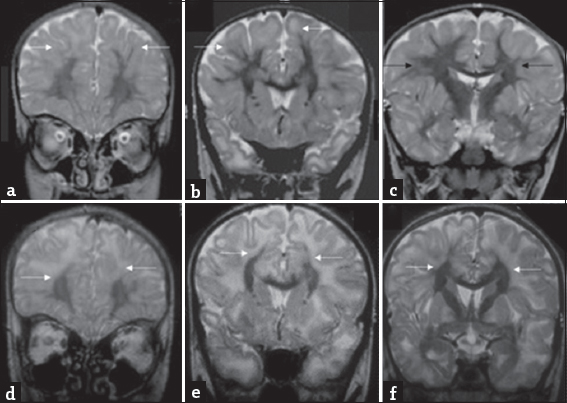 An 8-year-old boy presenting with progressive ataxia: Temporal evolution of white matter changes over 5-year interval. Initial magnetic resonance imaging shows confluent subcortical predominant white-matter hyperintensity (white arrows) with relative sparing of deep white matter (black arrows) on T2 coronal images (a-c). T2 coronal images at the same levels (d-f) from subsequent magnetic resonance imaging done after 5 years show more extensive deep white matter involvement (white arrows).