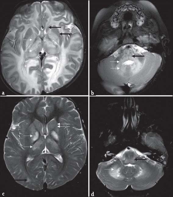 Differential diagnosis of L-2-hydroxy glutaric aciduria. Imaging features of an 1-year-old boy with macrocephaly and neuroregression diagnosed as Canavan disease; a 9-year-old boy with progressive external ophthalmoplegia, cardiac conduction defects, and deafness diagnosed as Kearns–Sayre syndrome: T2 axial images of Canavan disease (a and b) show extensive panlobar white-matter hyperintensity in subcortical, deep, and periventricular distribution along with symmetric globus pallidus and thalamic hyperintensity and swelling (white arrow). Caudate and putamen are spared (black arrows). Significant medullary (black arrow), cerebellar white matter (white arrows), and dentate hilus signal changes are noted. T2 axial images of Kearns–Sayre syndrome at the same levels (c and d) show symmetric globus pallidus and thalamic hyperintensity (white arrows), while caudate and putamen are relatively spared (double arrows). Note the subcortical predominant white-matter involvement in the occipital regions (black arrow). Medulla (black arrow), cerebellar white matter, and dentate nucleus (white arrows) also show hyperintense signal changes.