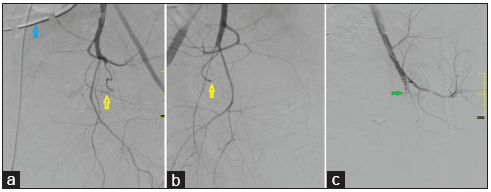 A 38 year primipara presented with refractory post partum haemorrhage despite obstetric hysterectomy. Angiogram revealed (a,b) ligated bilateral uterine arteries (yellow arrows). Note surgical drain placed in pelvis (blue arrows). (c) Anterior division of left internal iliac artery embolized with coils (green arrows).