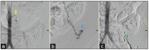 A 38 year primipara presented with refractory post partum haemorrhage. Aortic angiogram showed (a) Left ovarian artery (yellow arrow) arising from anterolateral aspect of aorta at L2 vertebral level. (b) Selective catheterization of left ovarian artery with progreat microcatheter demonstrating active contrast leak (blue arrow). (c) Left distal ovarian artery completely embolized by NBCA + Lipiodol (green arrow).