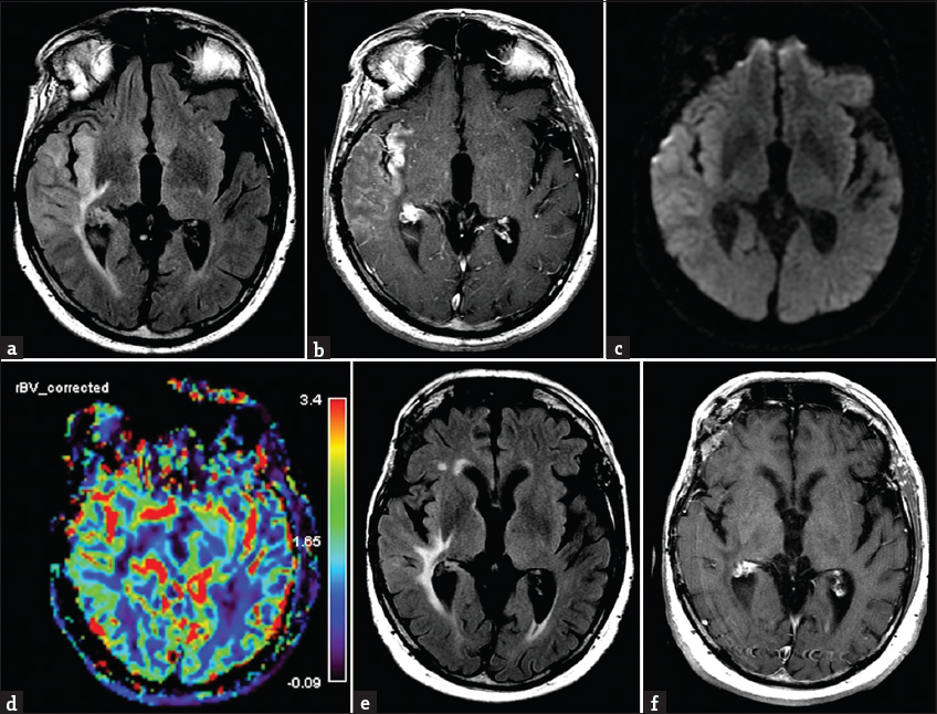 Brain magnetic resonance imaging demonstrating characteristic findings of stroke-like migraine attacks after radiation therapy syndrome. (a) Fluid-attenuated inversion recovery image demonstrates insular and temporal T2 hyperintensities near the site of prior radiated tumor, with corresponding gyriform enhancement on postcontrast T1-weighted axial image (b) and expected lack of abnormalities noted on diffusion-weighted (c) and perfusion (d) images. Posttherapy imaging at 10 days demonstrates improved signal abnormalities on (e) fluid-attenuated inversion recovery and reduced enhancement on (f) postcontrast T1-weighted sequences.