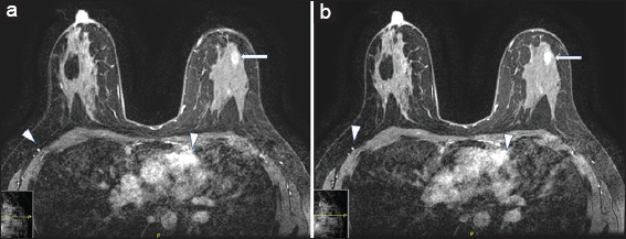 A 29-year-old female with ferumoxytol injection before breast magnetic resonance imaging. (a) Axial precontrast image demonstrating apparent enhancement in the heart and vasculature (arrowheads) and nonmass enhancement in the left breast (arrow). (b) Axial postcontrast image demonstrating similar enhancement in the heart and vasculature (arrowheads) and nonmass enhancement in the left breast (arrow).