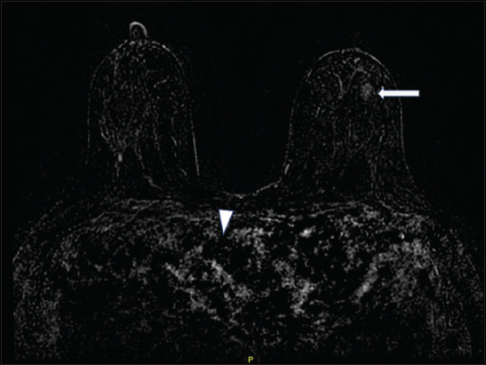 A 29-year-old female with ferumoxytol injection before breast magnetic resonance imaging. Subtraction image is extremely limited with no significant contrast noted in the heart and vasculature (arrowheads). Minimal nonmass enhancement is noted in the left breast (arrow).