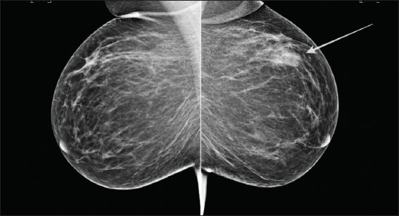 A 47-year-old female with a history of painless palpable mass within the left breast. Bilateral mammography showing an ill-defined mass in the left upper outer quadrant in keeping with biopsy-proven mammary angiomatosis (white arrow).