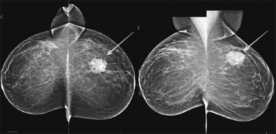 Three years later, the same patient represented with a history of recurrent left-sided palpable breast mass. Mammography: Local recurrence of the previously diagnosed left-sided angiomatosis demonstrated on mediolateral oblique and craniocaudal views. The mass appears much more dense and is more conspicuous than on prior imaging (white arrows).