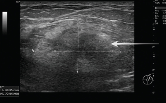 Three years later, the same patient represented with a history of recurrent left-sided palpable breast mass. Ultrasound of the left upper outer quadrant showing an irregular hypoechoic mass correlating with the mammographic abnormality and palpable lesion (white arrows).