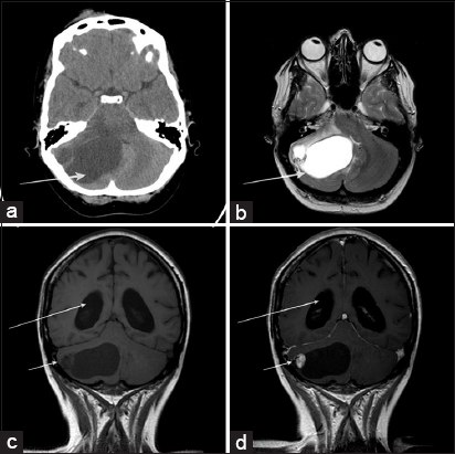 (a-d) Seven years before the initial symptomatic breast presentation, the patient had been admitted to the hospital with a history of nausea, dizziness, and unsteady gait. Noncontrast computer tomography (a) and T2-weighted magnetic resonance imaging (b) showed a well-defined posterior fossa cystic lesion in keeping with right-sided hemangioblastoma (white arrows). Pre- and postcontrast T1-weighted coronal sequences (c and d) confirm the typical appearances of a hemangioblastoma, i.e., a large cystic component and a small enhancing mural nodule (short white arrows). No enhancement evident in relation to the cystic component. Associated hydrocephalus also evident (long white arrows).