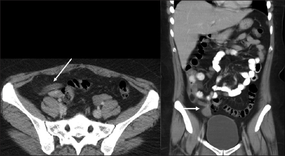 A 69-year-old female, axial and coronal computed tomography scan showing thickened heterogeneously enhancing mass at the tip of appendix measuring up to 18 mm, proximal appendix measured up to 8 mm in diameter without evidence of periappendiceal inflammatory changes concerning for the appendiceal tumor.